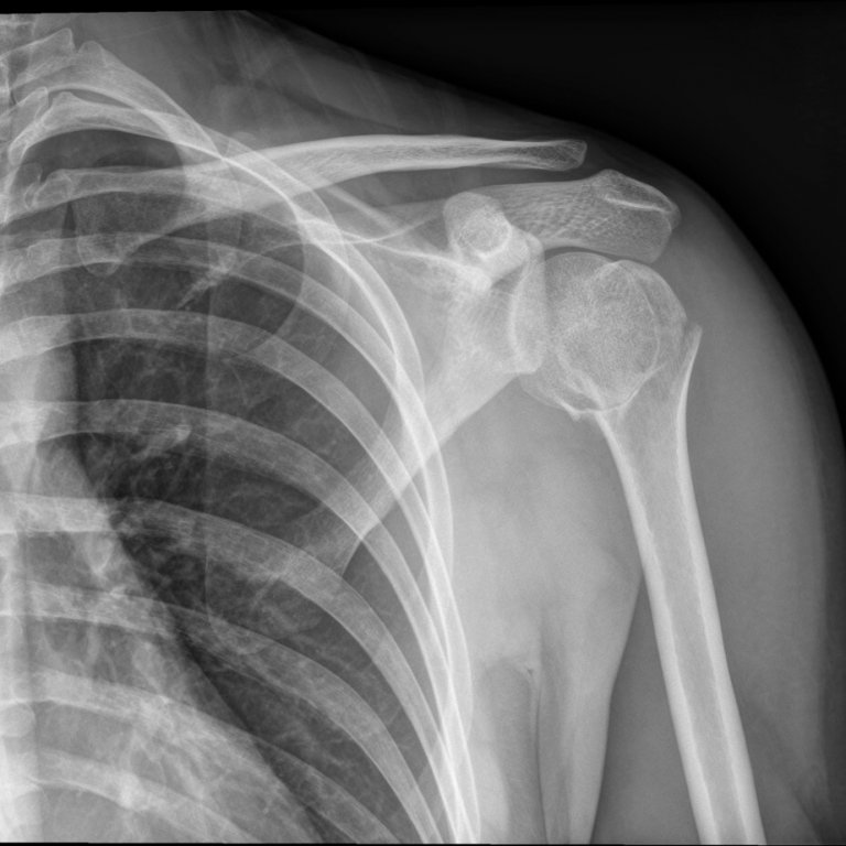 Shoulder Fracture